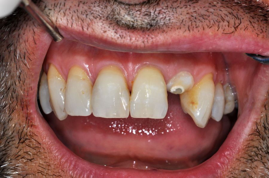 teeth in a day - before